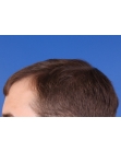 Before Hair Transplant &nbsp;Hairlines